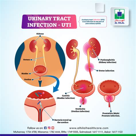 UTI (Urinary Tract Infection) .